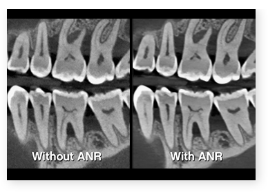 Advanced noise reduction ANR