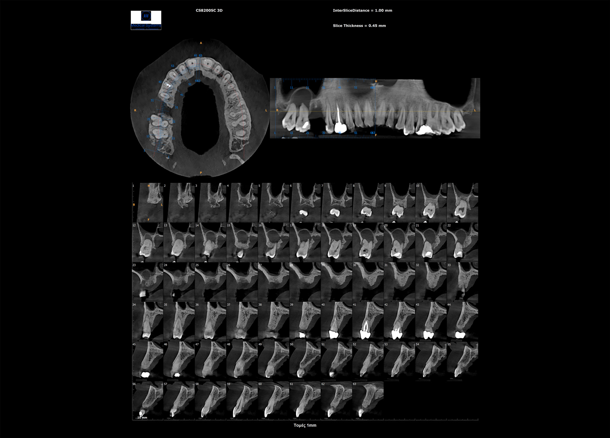 Τομές 3D από ψηφιακό πανοραμικό