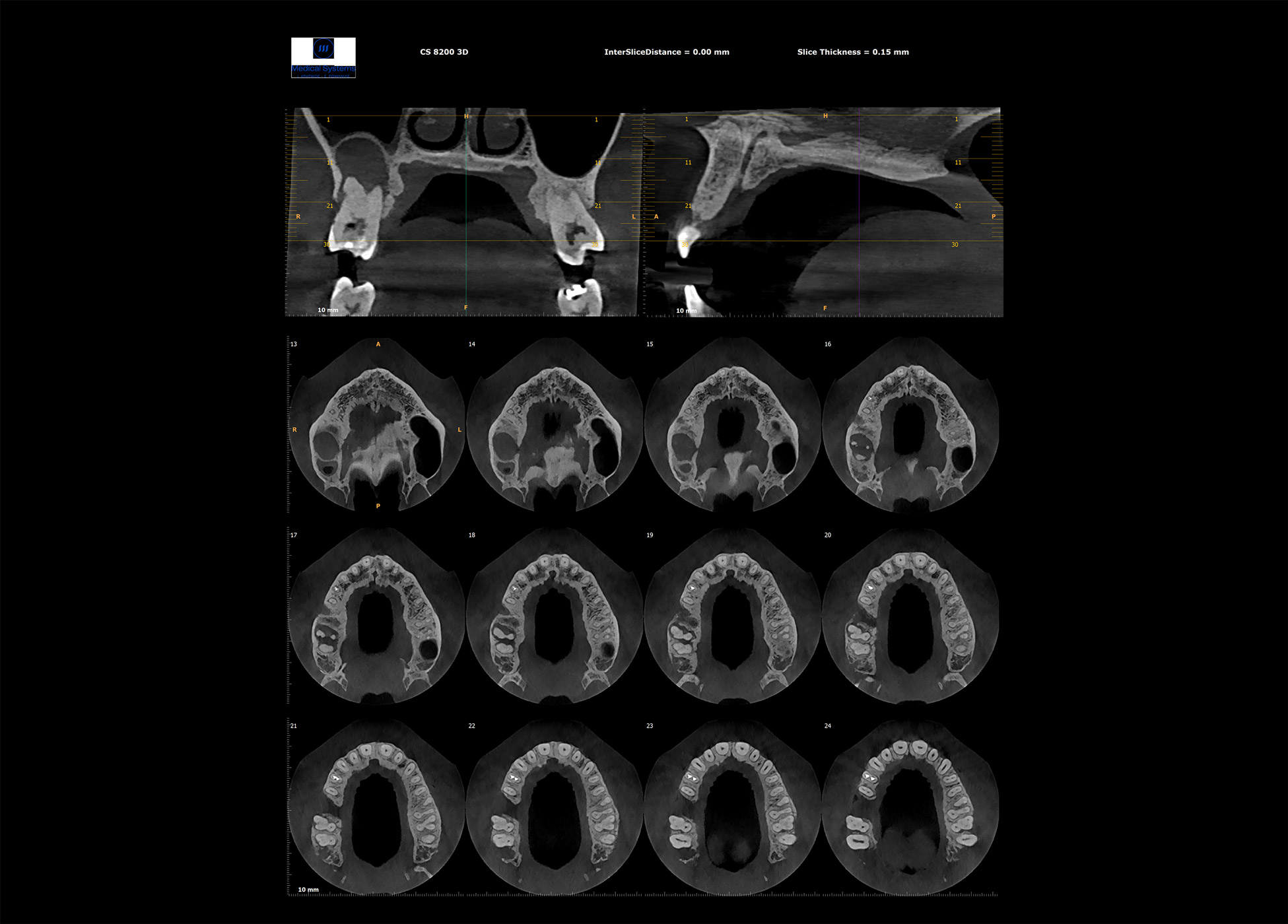 Τομές 3D από ψηφιακό πανοραμικό