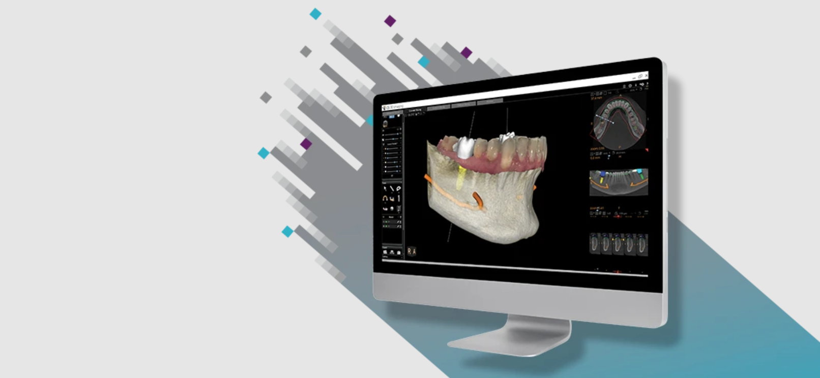 3D imaging software της Carestream Dental
