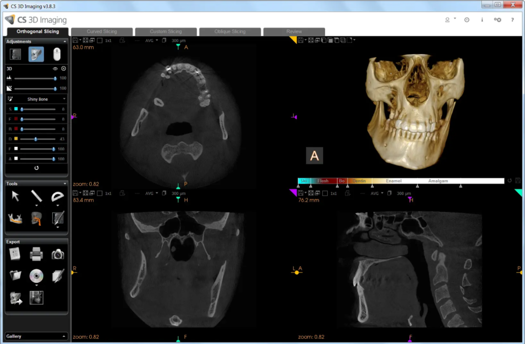 3D imaging software της Carestream Dental